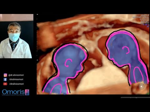 Vídeo: Es podrien perdre els bessons en una ecografia?