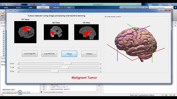 Detect tumor from brain MRI using matlab