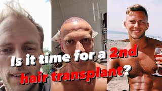 2 years after hair transplant - AM I GOING BALD AGAIN?