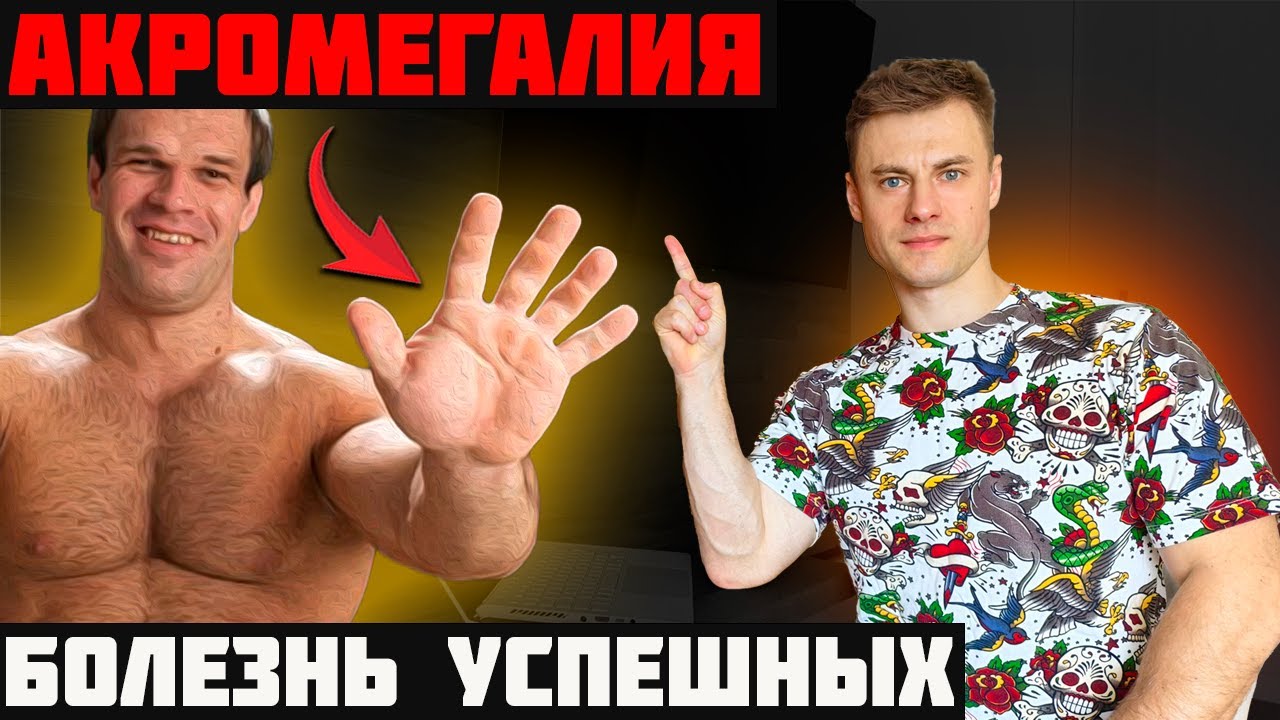 АКРОМЕГАЛИЯ. Болезнь успешных...?