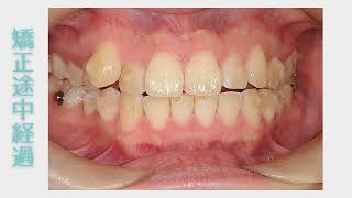 がたがた歯並び（叢生）の矯正治療症例｜呉市のうえはら歯科