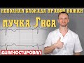 Блокада правой ножки пучка Гиса