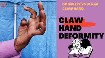 Claw Hand ( true claw hand) & causes  #ulnarclawhand #median-nerve #lumbricals #handmuscles