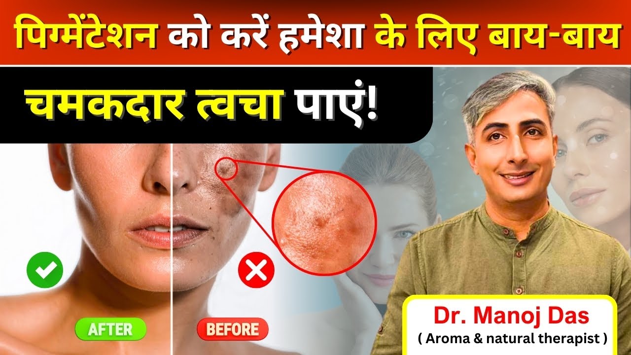 How to treat PIGMENTATION I Natural remedies for pigmentation I Melasma Treatment I DR  MANOJ DAS