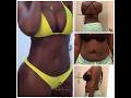 Tummy Tuck Before & After Results! #tummytuck #bbl #liposuction #plasticsurgery #shorts