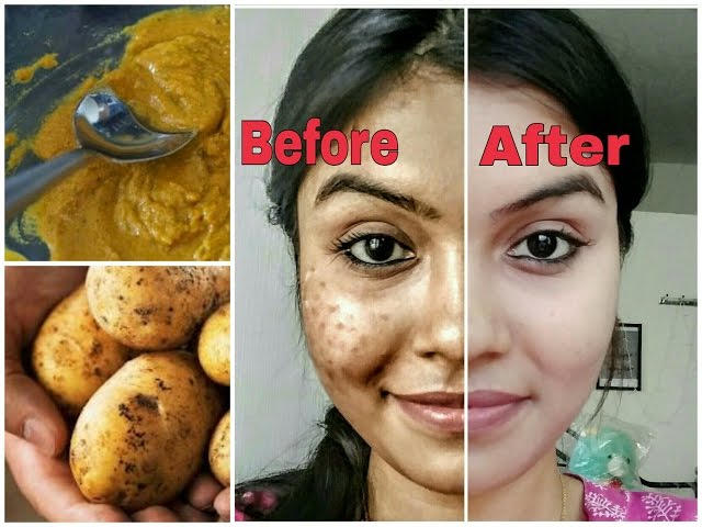 potato cream for dark spots