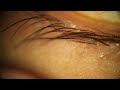 Ingrown eyelash with needle