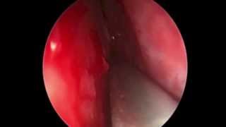 Celulitis orbitaria de definicion