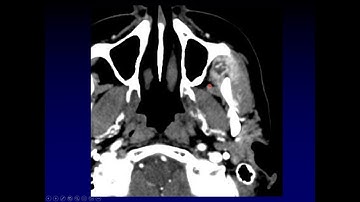 Quick Case: Aggressive Infratemporal Mass