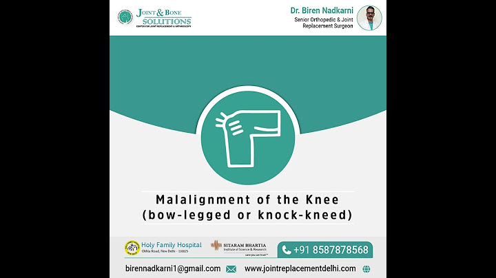 When Should One Consider Bracing for Knee Osteoarthritis?| Best Knee Osteoarthritis Treatment Delhi
