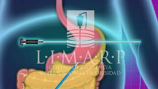 Bariclip Tijuana México - Limarp Dr. Pompa