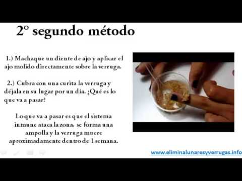 verrugas en el cuello Como eliminar las verrugas (Método Natural)