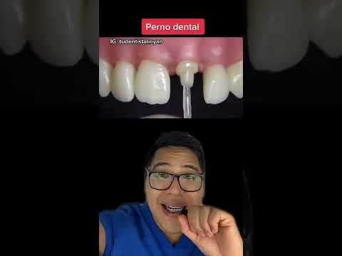 MuelinFlash #12: ¿Qué es un PERNO DENTAL?