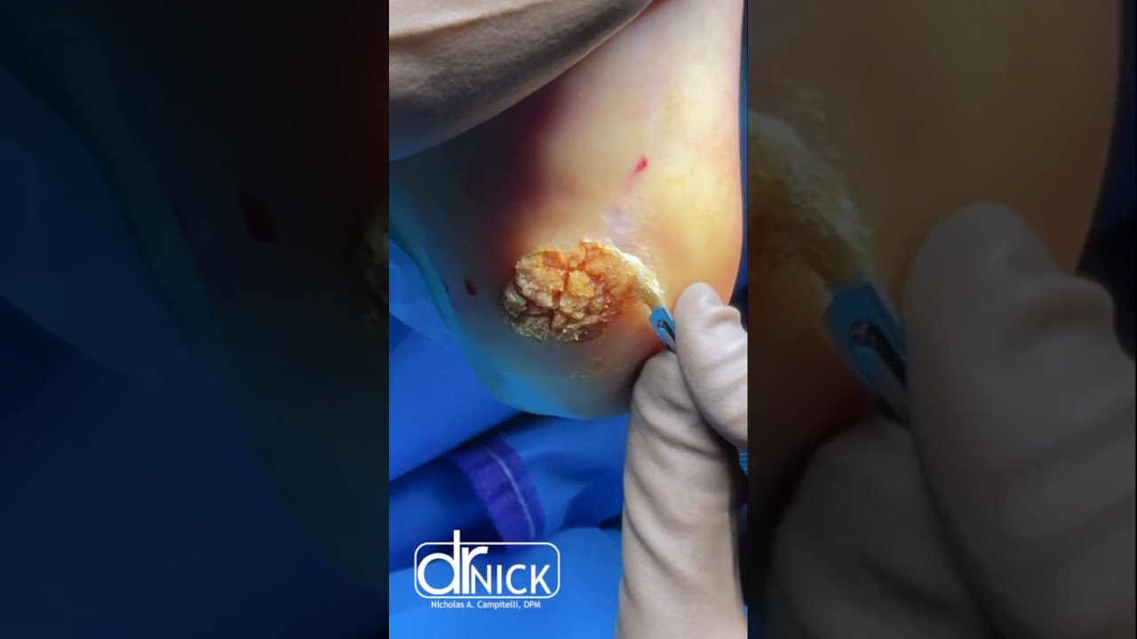 Removing A MASSIVE Plantar WART Shorts
