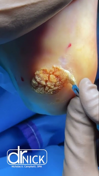 Removing a MASSIVE Plantar WART!! #shorts