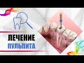 Пульпит - лечение каналов зуба за 5 шагов! [ Диагностика, симптомы, последствия ].