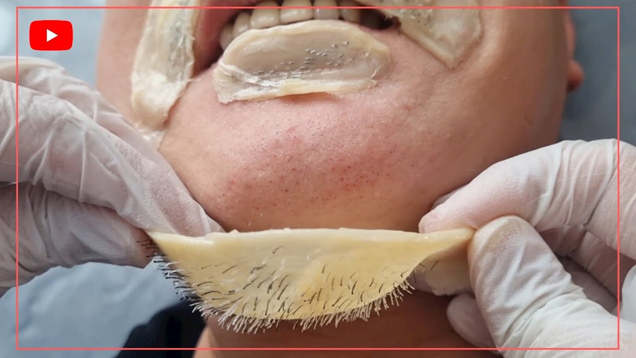 (충격🥶) 모근 털 뿌리까지 수염 왁싱하기 Waxing your beard to the root
