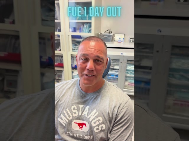 One Day Out FUE in Dallas, Texas