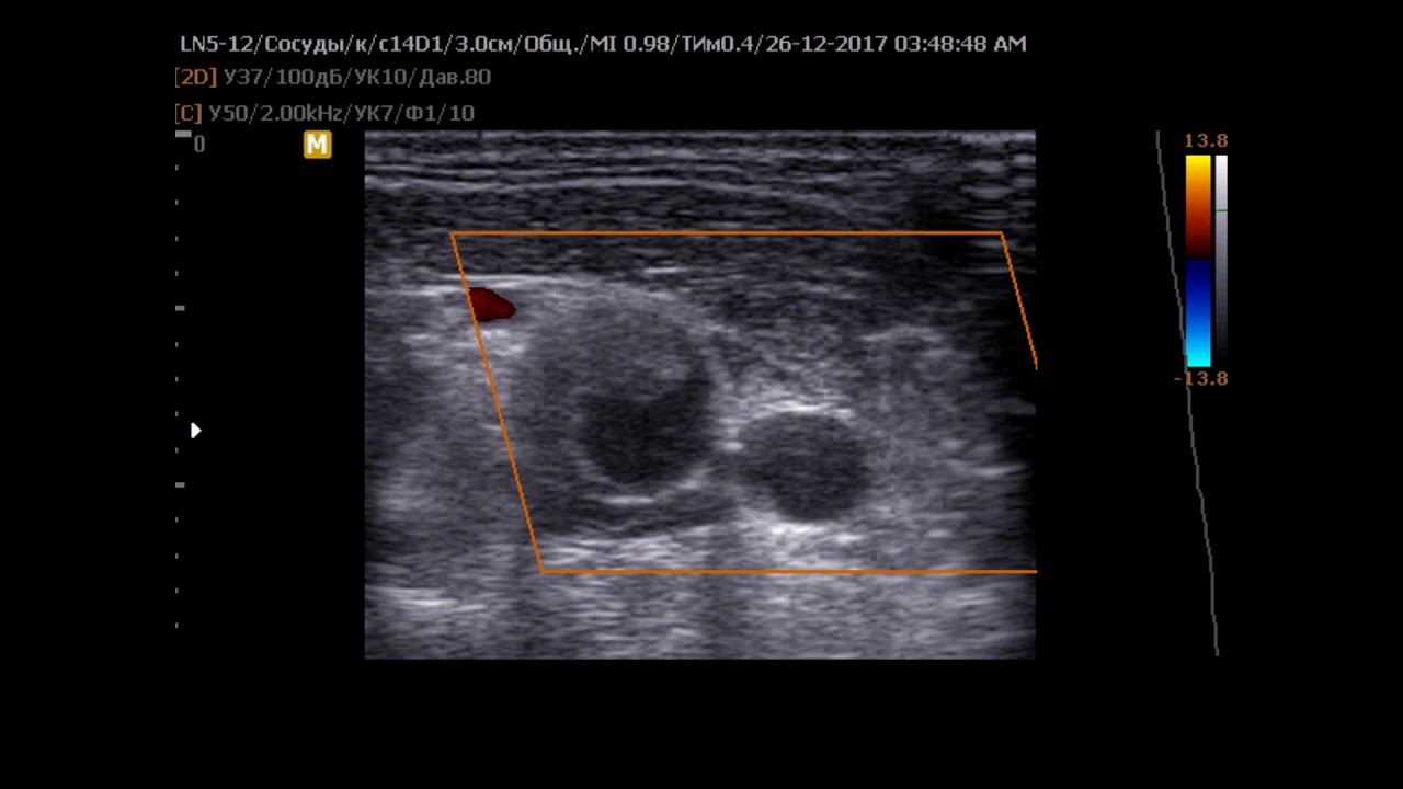 Узи вен тромбоз. Аневризма подколенной артерии на УЗИ. Аневризма общей сонной артерии на УЗИ. Тромбоз яремной вены на УЗИ. Тромбоз аневризмы брюшной аорты УЗИ.
