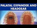 Orthodontic devices - Palatal expander and headgear ©