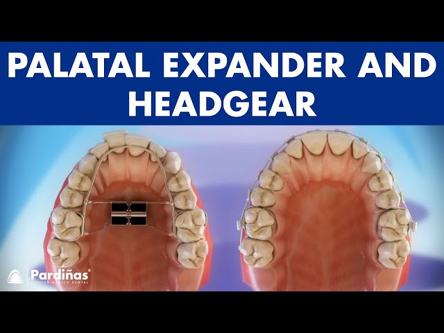 What Is a Headgear Palate Expander and How Can It Help Improve Your Orthodontic Treatment?