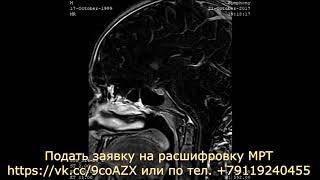 На расшифровке МРТ гипофиза обнаружена МИКРОАДЕНОМА. Запись на платную КОНСУЛЬТАЦИЮ НЕВРОЛОГА.