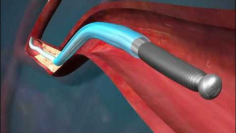 Cardiology - Stent Deployment Procedure