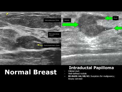 Breast Ultrasound Normal Vs Abnormal Image Appearances Comparison | BI-RADS Classification USG