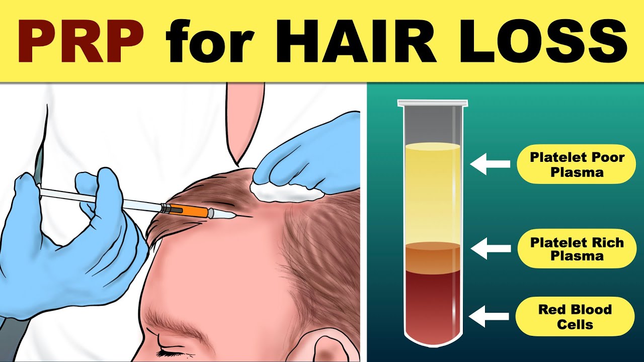 PRP Hair Treatment | prp hair loss treatment before and after | Hair loss  Treatment - YouTube