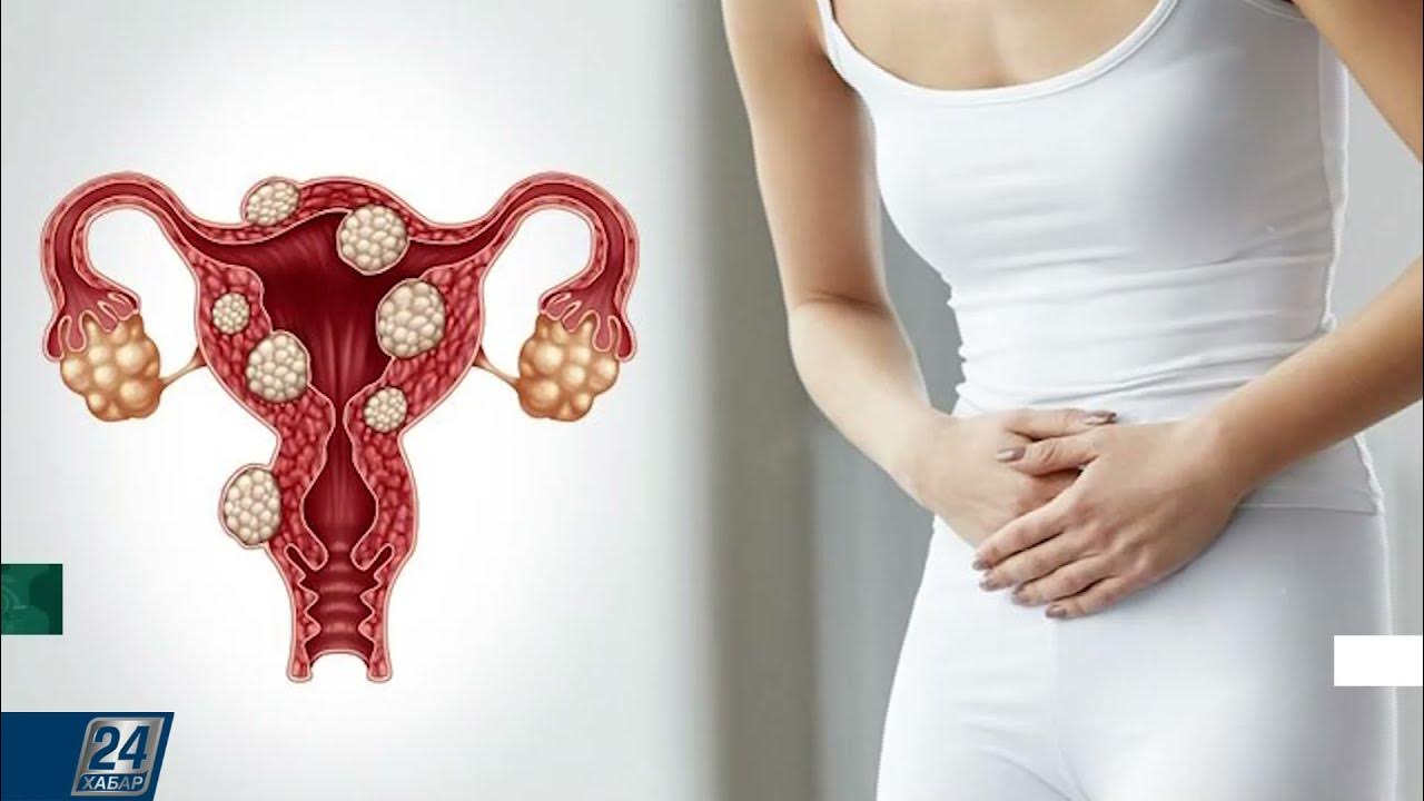 Доброкачественные миомы: фото и информация Картинки жизни prik-rgbuz.ru