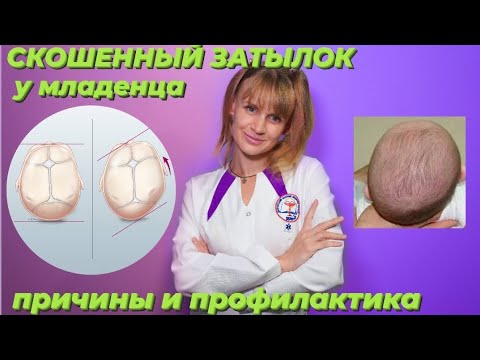 Деформация черепа у младенца. Плагиоцефалия. СКОШЕННЫЙ ЗАТЫЛОК: причины и профилактика