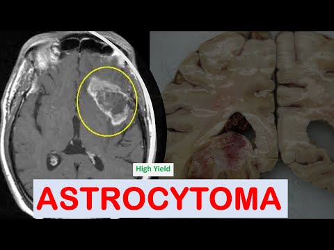 Video: Pilocytisk Astrocytom: Symptomer, Overlevelsesrater Og Behandling