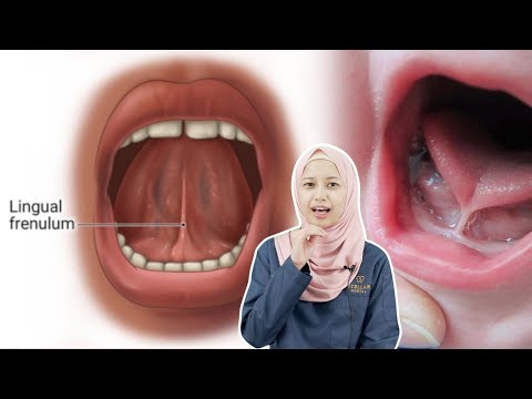 Video: Bolehkah tongue tie membuat bayi rewel?