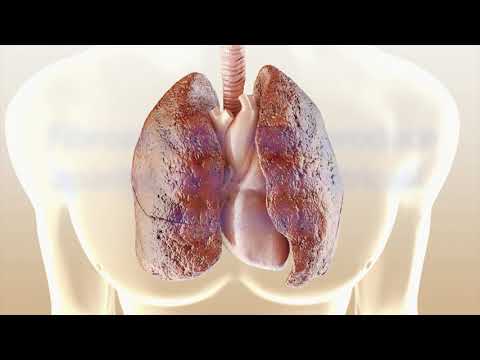 Spot informativ despre Fibroza pulmonara idiopatica
