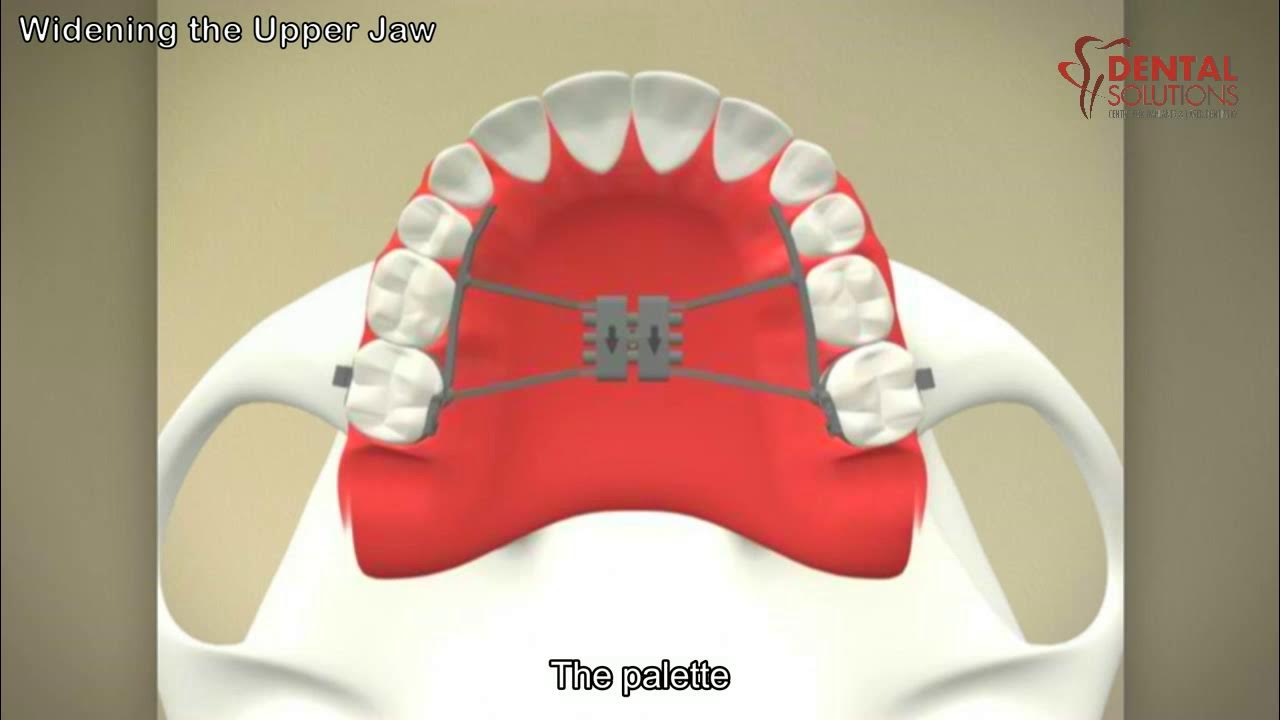 Widening the Upper Jaw Palatal Expanders YouTube