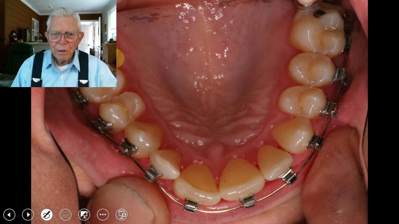 Expansion of the Adult Palate & Teeth With BigDaddy Arch