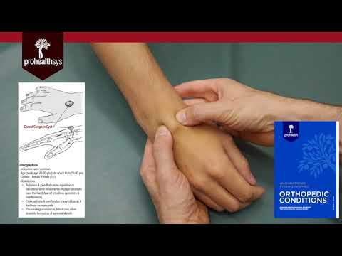 Ganglion Cyst of Wrist Diagnosis and Treatment Dr Vizniak