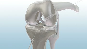 MEDHOLD curved anatomic soft tissue acl reconstruction using xo button