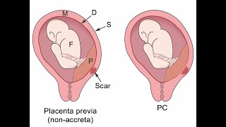 Understanding Placenta Accreta_An Introduction