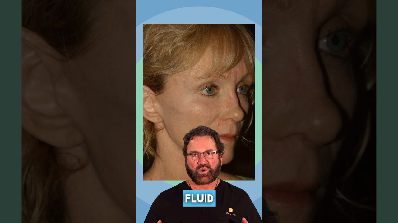 How do you get rid of malar fat?