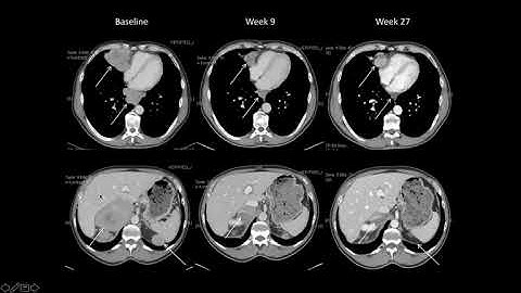 The PEMDAC phase 2 study of pembrolizumab and entinostat in patients with metastatic uveal melanoma