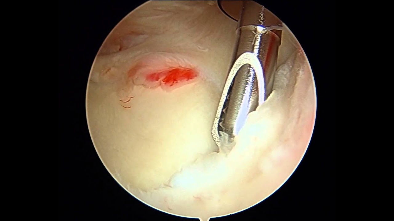 Anterior And Posterior Repair Failure Symptoms - xyzworldesign