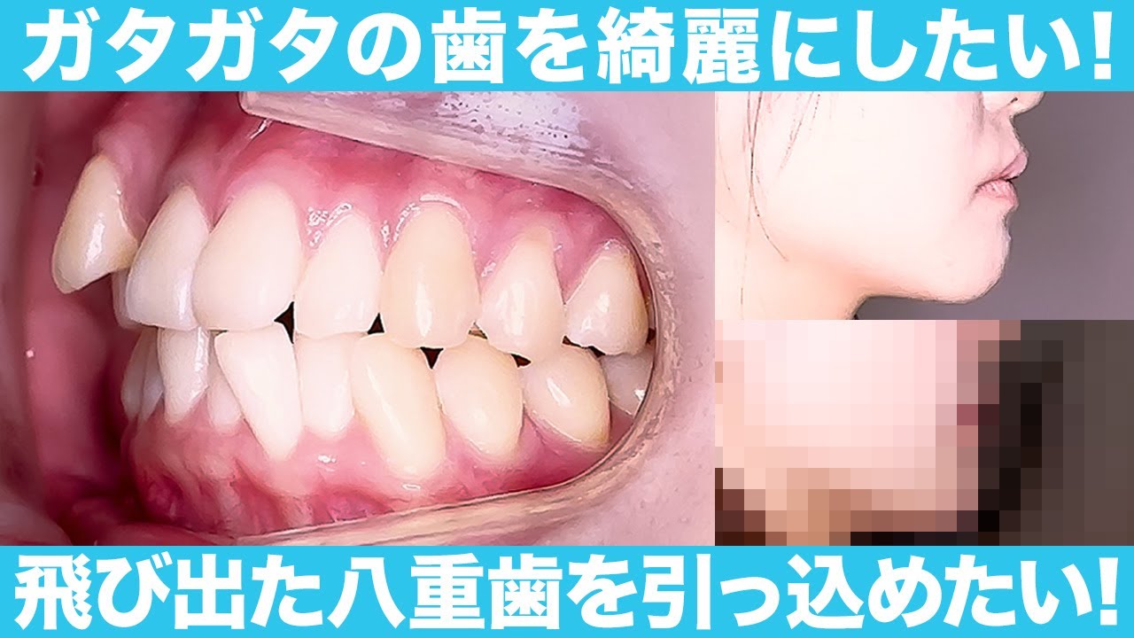 八重歯・隠れガチャ歯はワイヤー矯正が最適！実際の症例3選を解説 