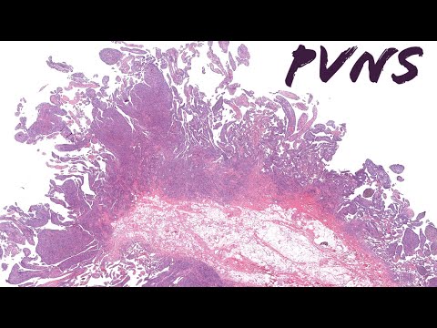 PVNS (pigmented villonodular synovitis/tenosynovial giant cell tumor diffuse type) pathology