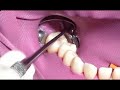 How to use sonicfill bulk fill resin composite by assoc profsaijai tanthanuch