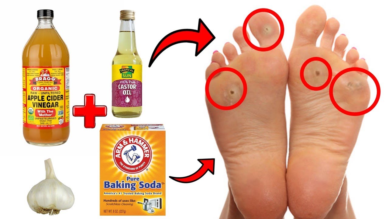 14 Proven Home Remedies For Corns  Callus Removal That Work!