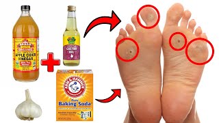 14 Proven Home Remedies For Corns & Callus Removal THAT WORK! screenshot 3