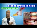 Cost of Braces and Aligners in Nepal / Dr Bikash Vlog