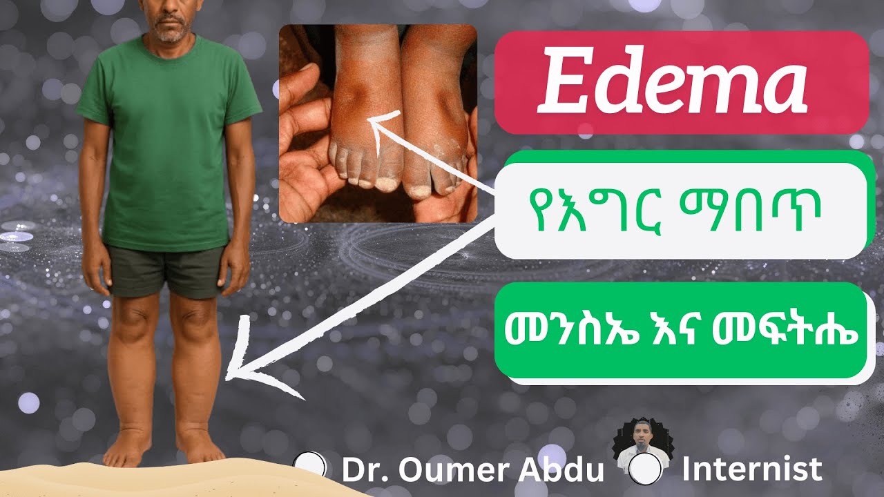ስለ እግር ና ሆድ ማበጥ---- የአሞክሳሲሊን አጠቃቀም What causes #edema #leg swelling? #amoxicillin