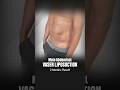 Male Abdominal VASER Liposuction | 2-Month Belly Fat Transformation #beforeaftershorts